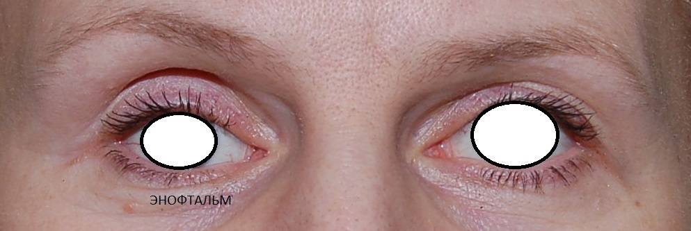 Микрофтальм глаза: лечение, причины, симптомы, диагностика и осложнения