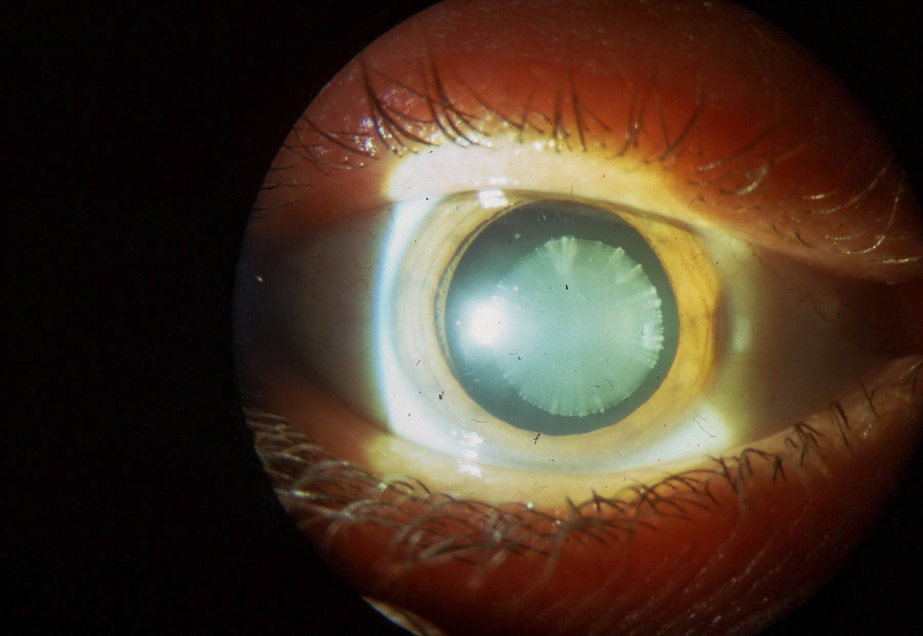 Почему мутно на глазу после операции по катаракте
