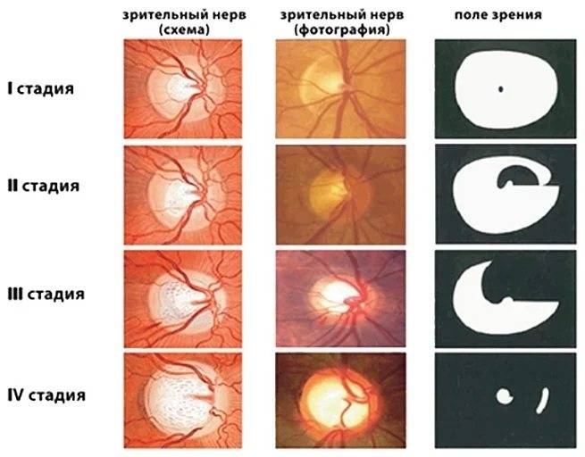 Что такое центральная хориоретинальная дистрофия сетчатки глаза и как она влияет на глаз?