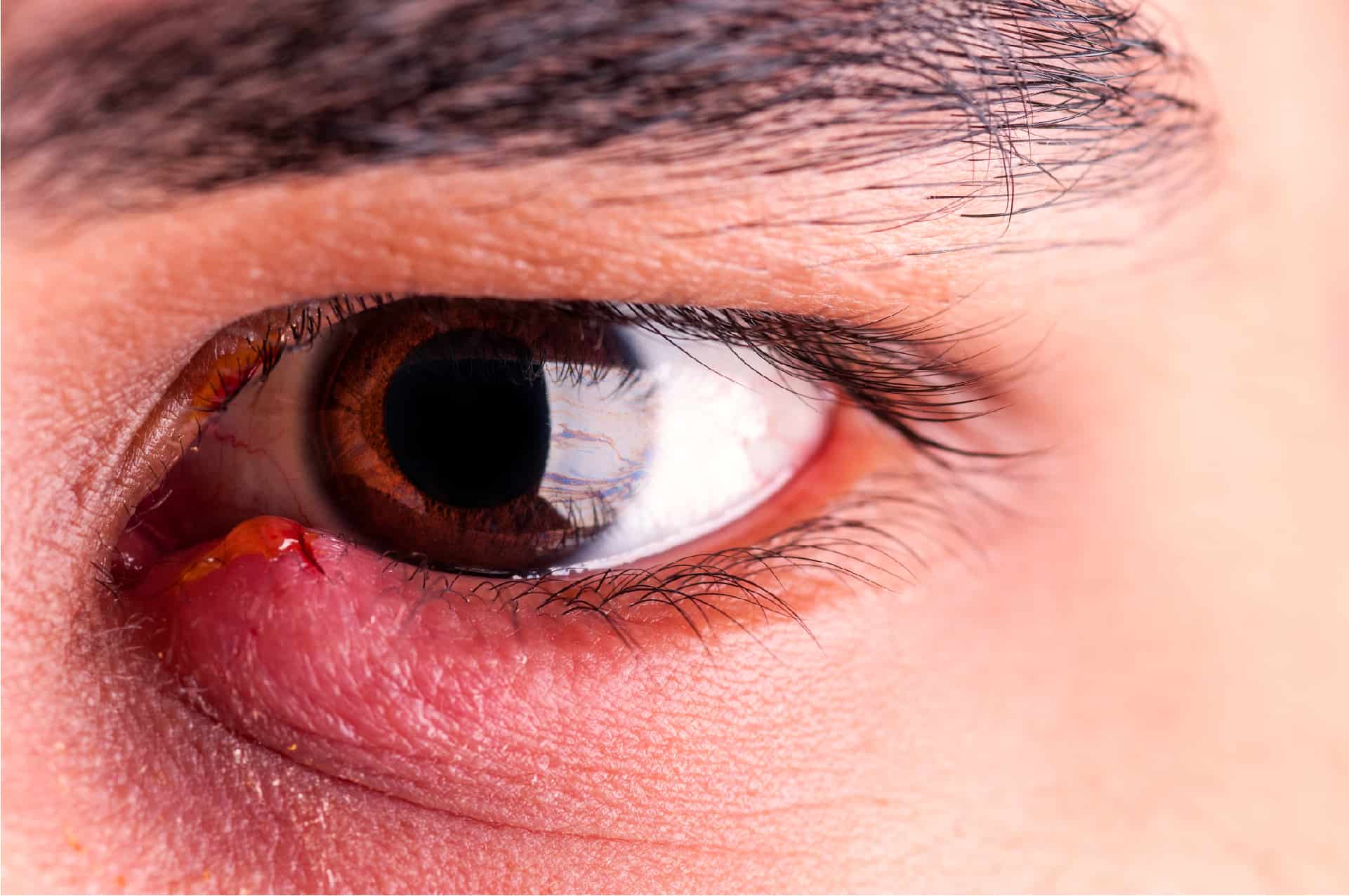 Ячмень на глазу (гордеолум): симптомы, причины и лечение