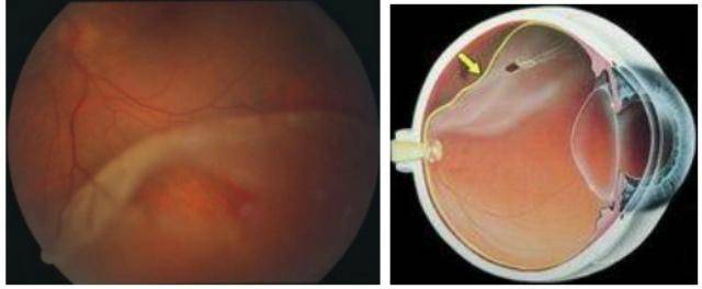 Варианты проведения операции на сетчатке глаза