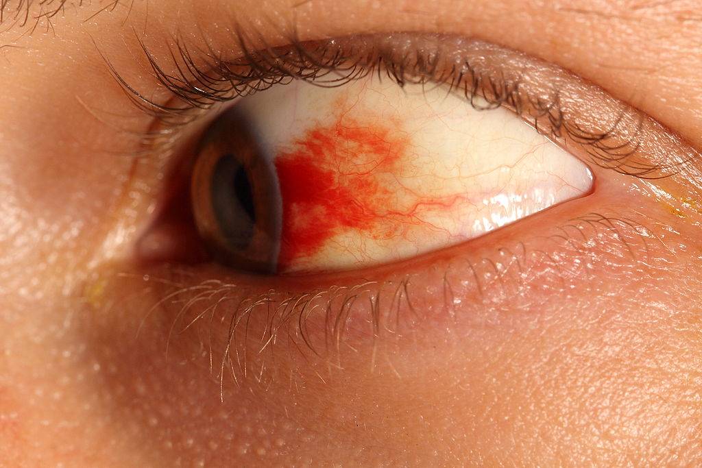 Глазные капли от кровоизлияния в глазу