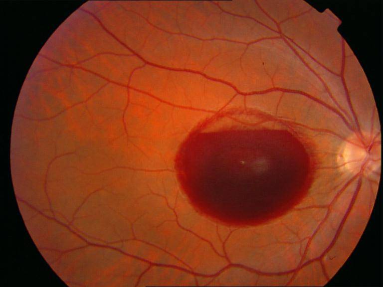 Макулодистрофия сетчатки глаза: возрастная, сухая и влажная формы, причины и лечение