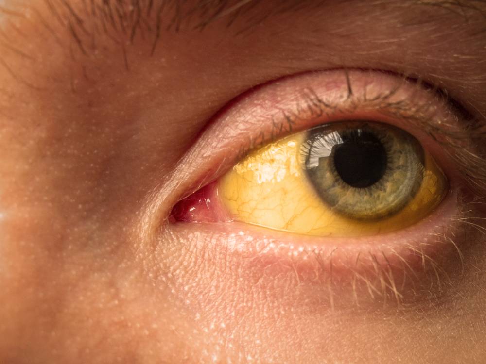 Белки глаз желтые: причины и как лечить