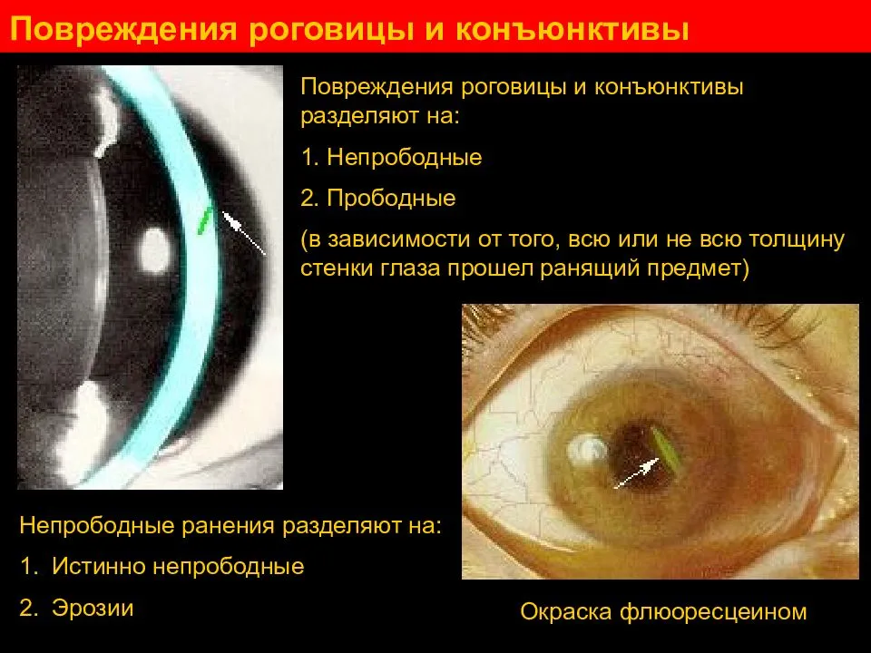 Хемоз конъюнктивы глаз: что это, cимптомы и лечение