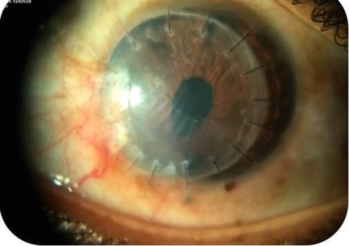 Пересадка роговицы глаза (кератопластика): ход операции, сколько стоит, отторжение