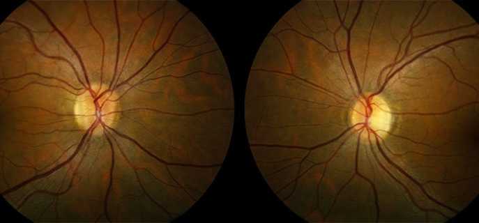 Как проявляется и лечится отек зрительного нерва?