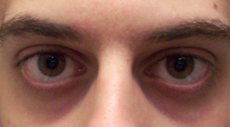 Надоедливые синяки под глазами: причины и лечение у мужчин