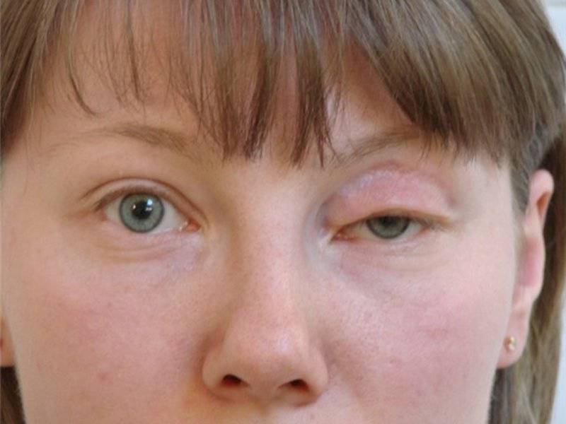 Причины экзофтальма одного глаза или обоих, симптомы и лечение
