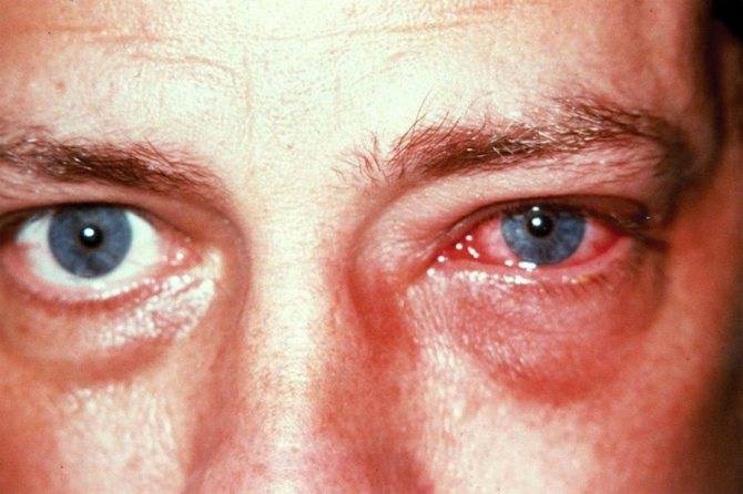 Причины покраснения и нагноения глаз у взрослого человека