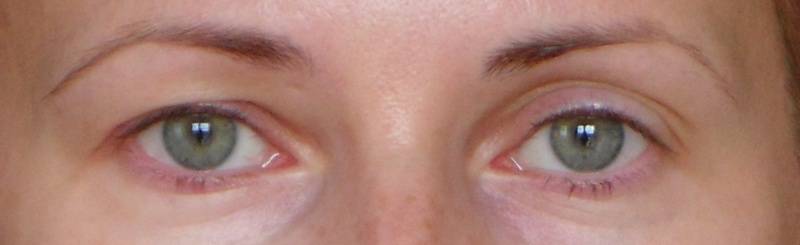Один глаз видит хуже другого - почему левый или правый глаз видит плохо