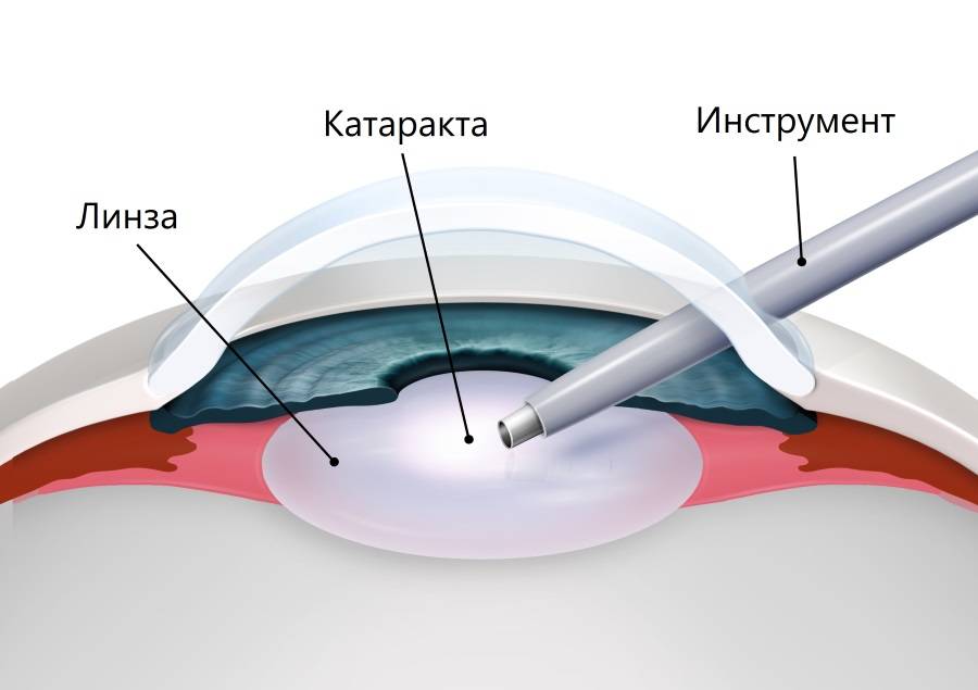 Замена хрусталика глаза при катаракте – послеоперационный период