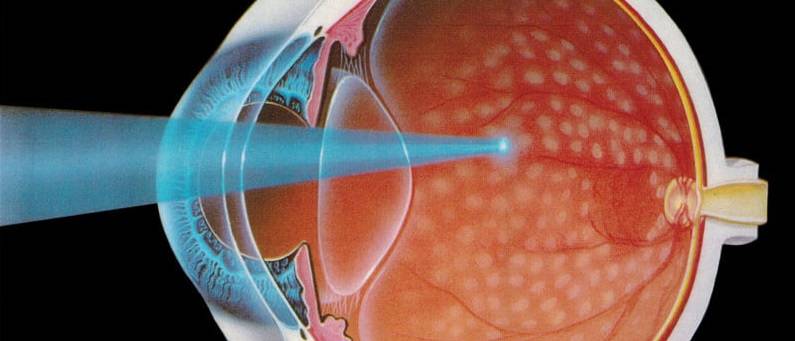 Проведение лазерного укрепления сетчатки глаза