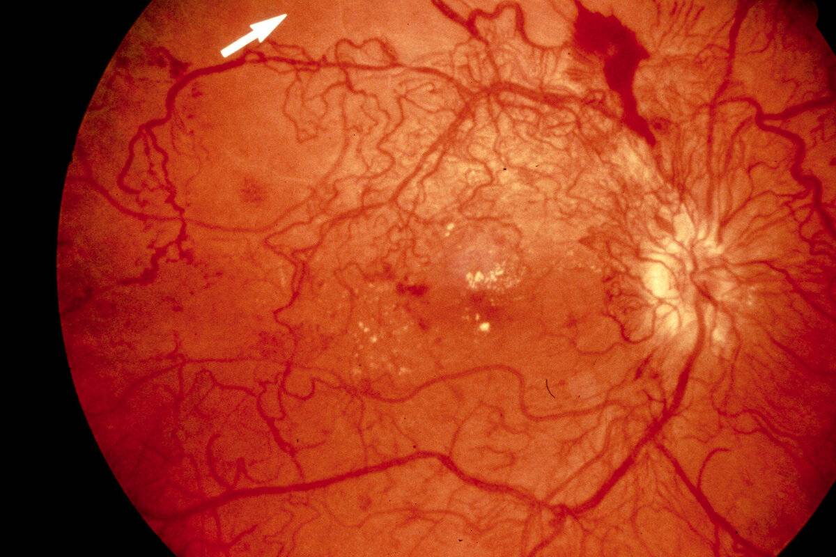 Диабетическая ретинопатия при сахарном диабете: лечение, стадии