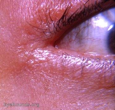 Правильное лечение герпеса на веках и возможные осложнения для слизистой глаза