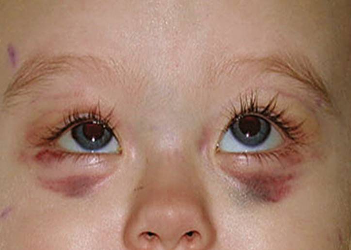 Сколько проходит синяк под глазом: сроки, лечение, маскировка - "здоровое око"