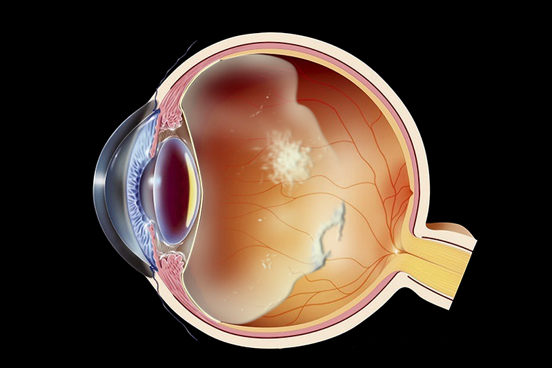 Отслоение сетчатки глаза: лечение, виды, симптомы и диагностика — глаза эксперт