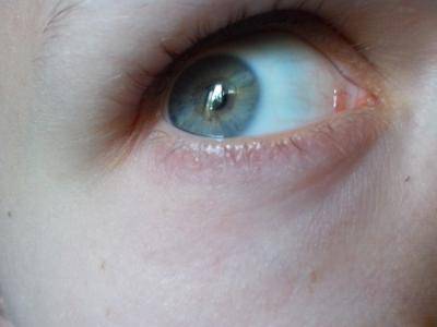 Желтые белки глаз у новорожденных - причины, последствия, лечение