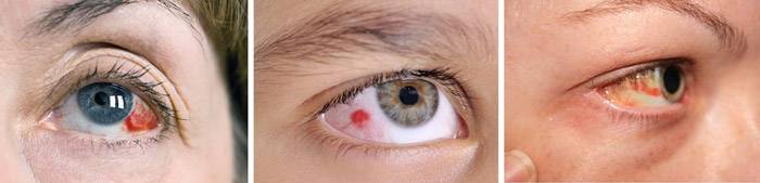 Стоит ли паниковать при появлении кровоизлияния в глазу
