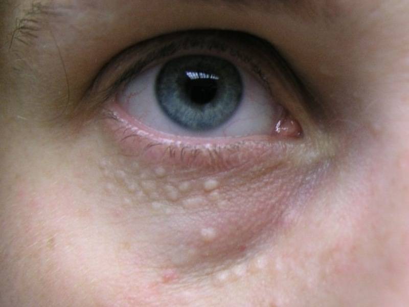 Красные круги под глазами почему. причины возникновения симптома у взрослых