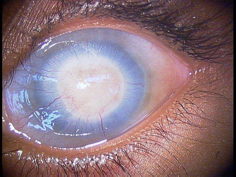 Помутнение в глазах: причины и методы лечения oculistic.ru
помутнение в глазах: причины и методы лечения