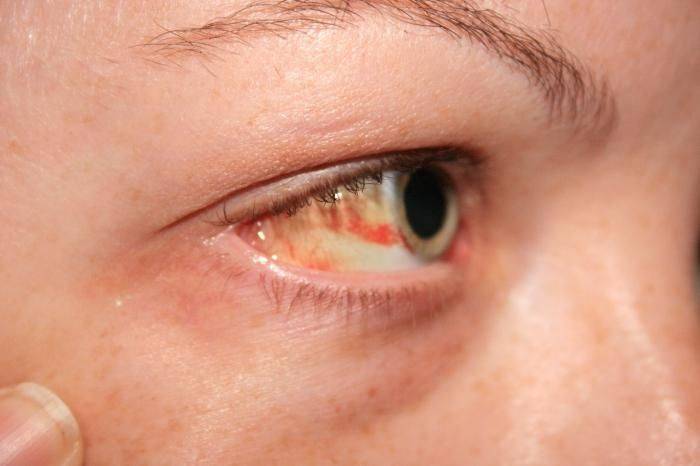 Воспаление глаза симптомы и лечение - лечим сами