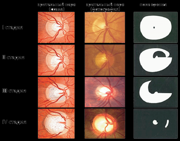 Симптомы глаукомы на ранних стадиях: лечение, профилактика, открытоугольная, закрытоугольная, приступ, в домашних условиях