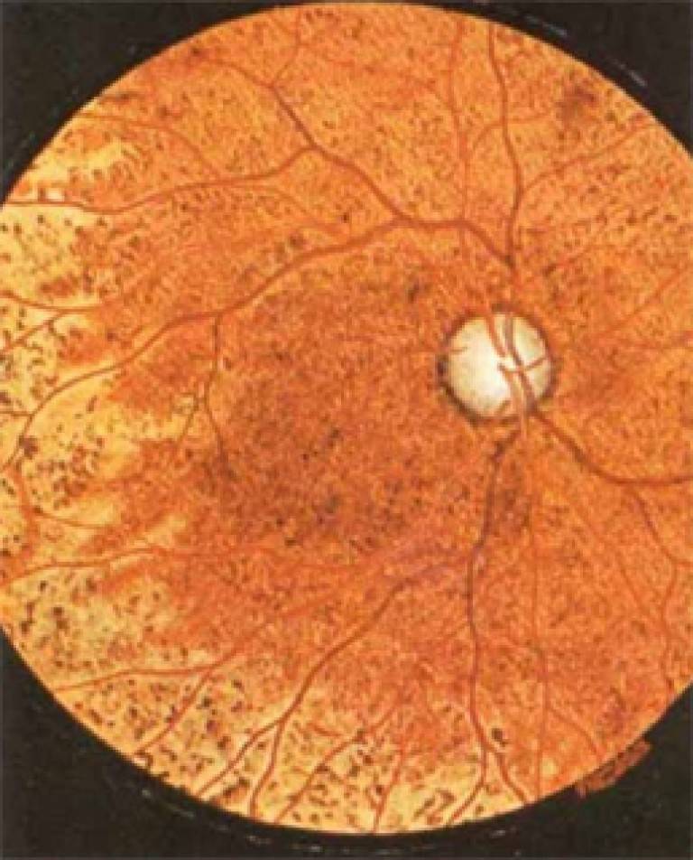 Центральная серозная хориоретинопатия глаза: лечение, симптомы, причины и осложнения