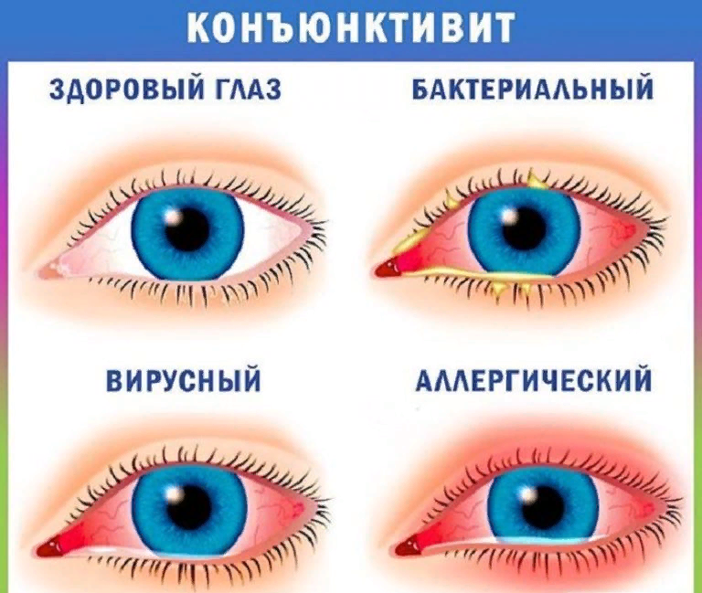 Красные глаза у грудничка: почему возникает такая проблема и как с ней справиться?