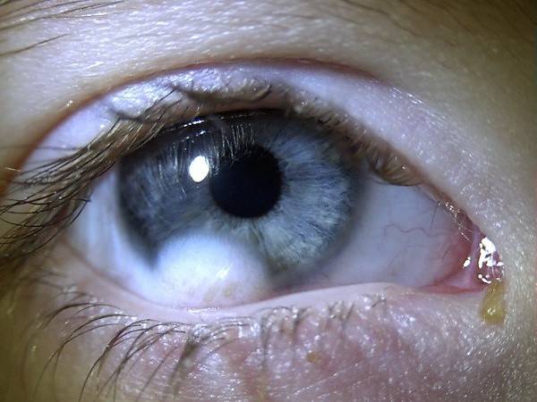 Лейкома роговицы глаза - что это, лечение, последствия