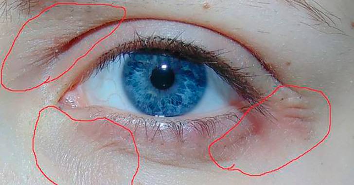 Воспаление и покраснение внешнего уголка глаза: причины и лечение