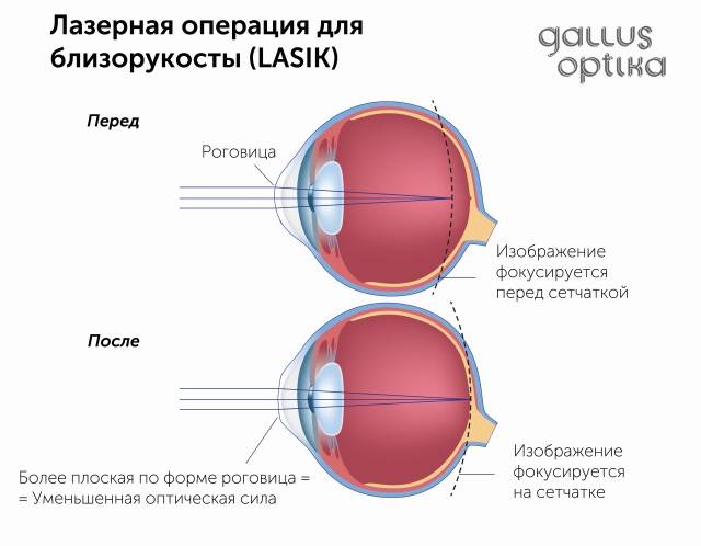Операция на глаза при близорукости: стоимость, виды коррекции миопии (лазерная, замена хрусталика)