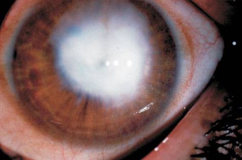 Заболевания роговицы глаза: фото, описание болезней