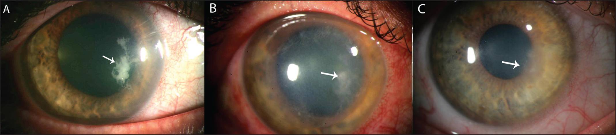 Кератит глаз (воспаление роговицы): что это такое, симптомы и лечение