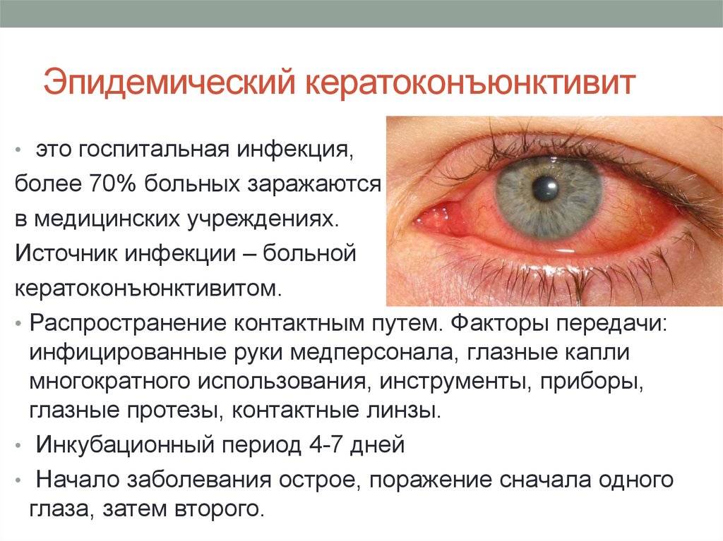 Кератоконъюнктивит: симптомы, причины, лечение - "здоровое око"