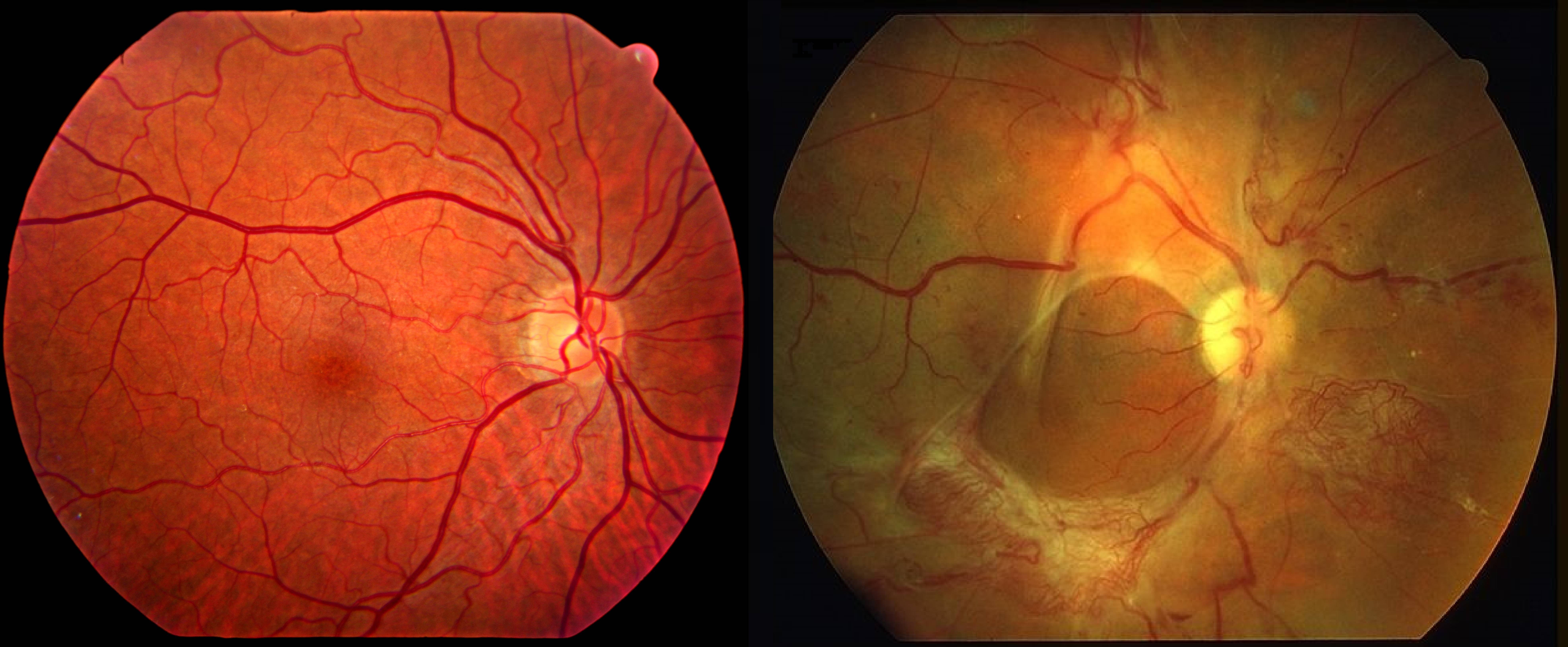 Симптомы проявления диабетической ретинопатии и её лечение