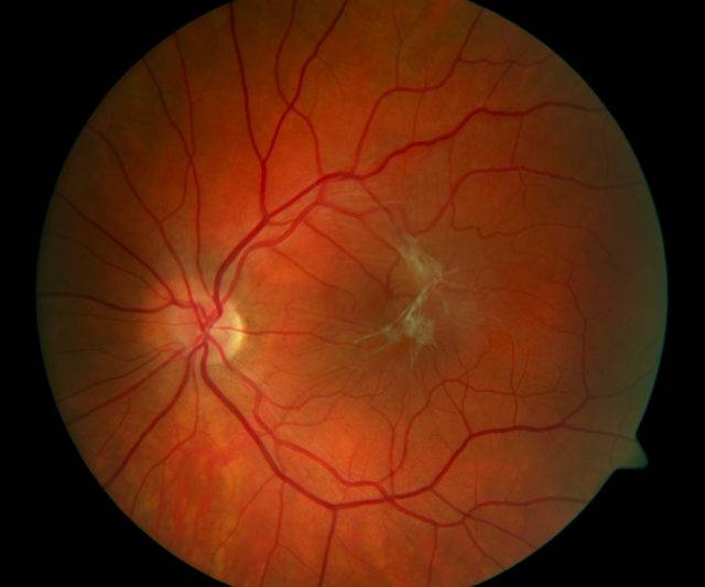 Отслоение сетчатки глаза – симптомы, методы лечения, операция