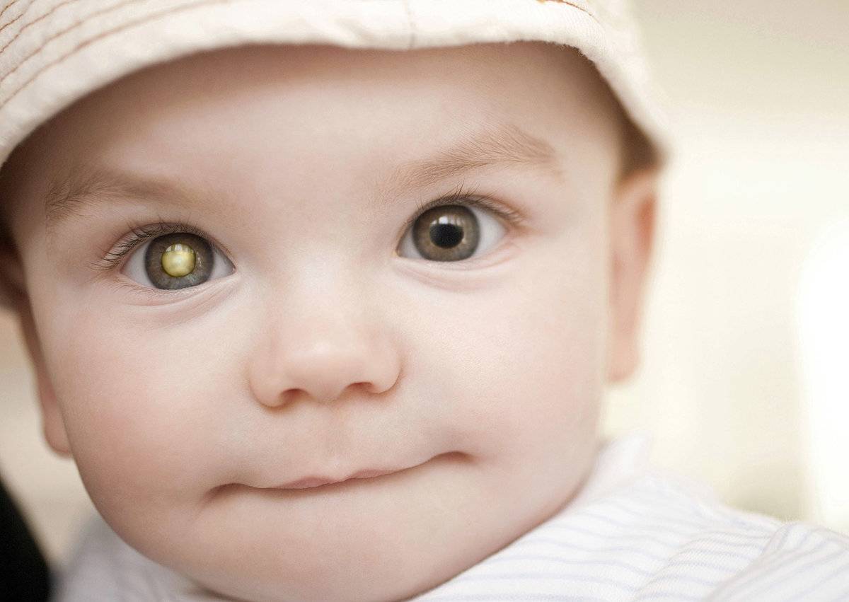 Ретинобластома глаза у детей: симптомы, прогноз, лечение