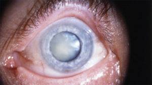 Незрелая катаракта: что это такое, как распознать, нужна ли операция