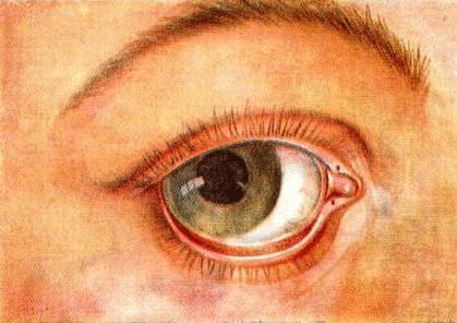 Выворот века у человека (эктропион глаза): формы, способы лечения и диагностика