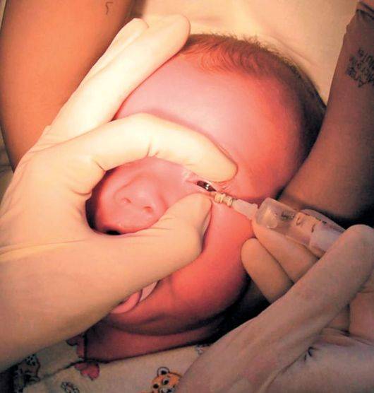 Комаровский - массаж слезного канала у новорожденных: массаж глаза при непроходимости слезного канала
