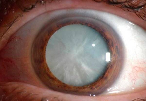 Лечение факосклероз хрусталика глаза