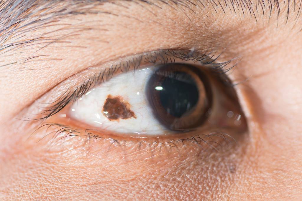 Невус (родинка) на глазу: причины появления, симптомы, методы лечения - "здоровое око"
