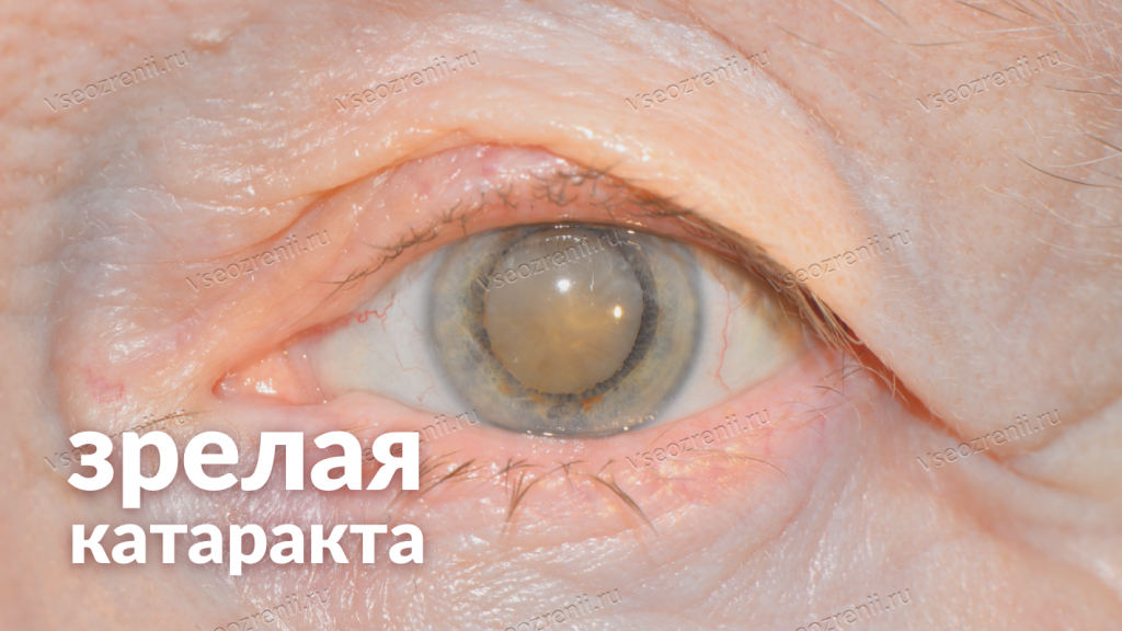Особенности лечения катаракты у пожилых людей, эффективные методики