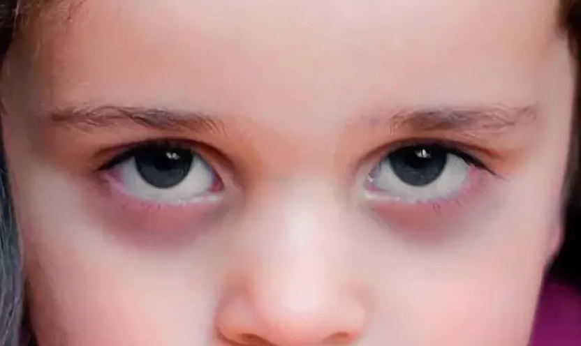 У ребенка мешки под глазами: причины и что делать