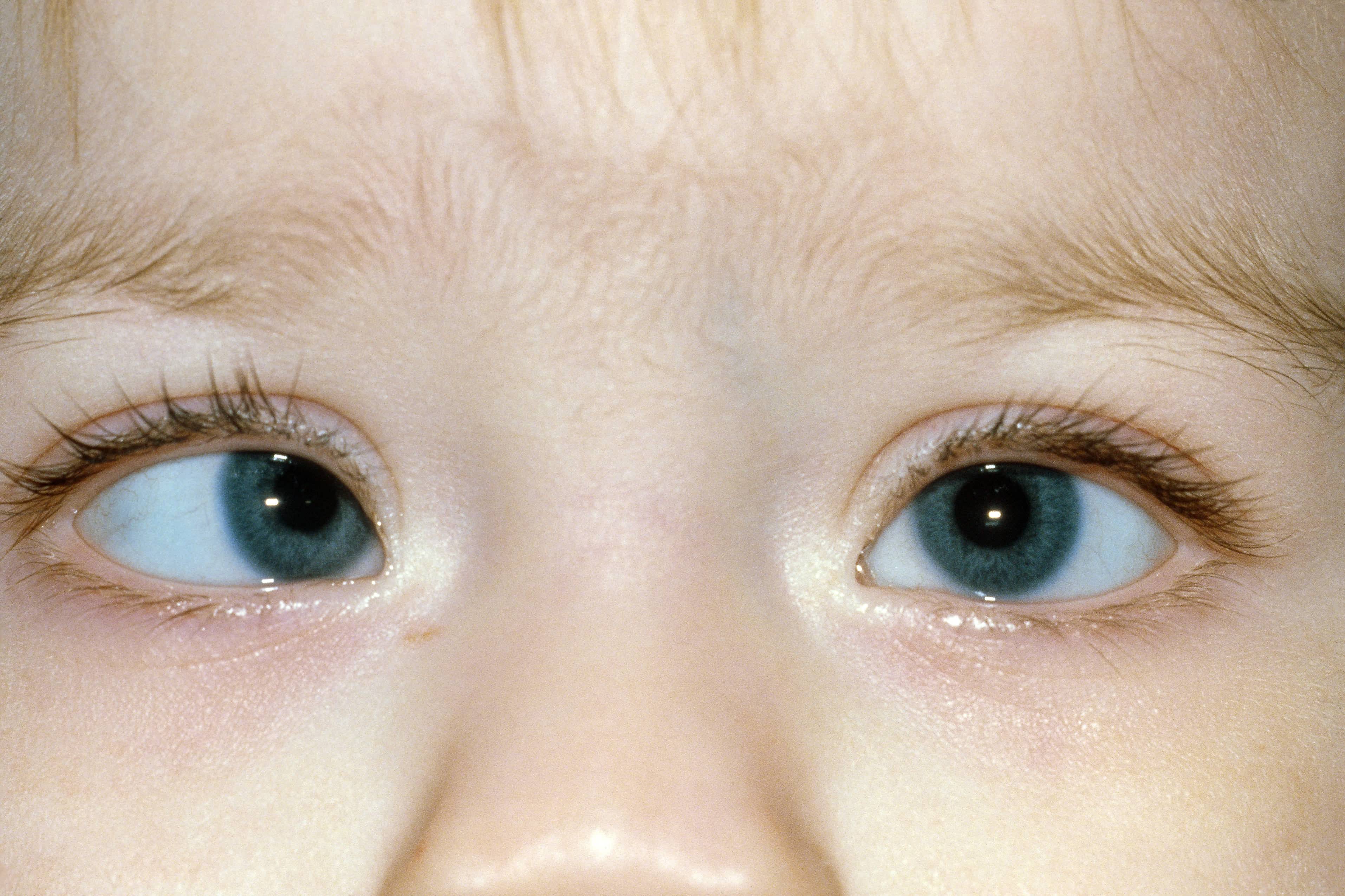 Нистагм у детей: симптомы и лечение — глаза эксперт