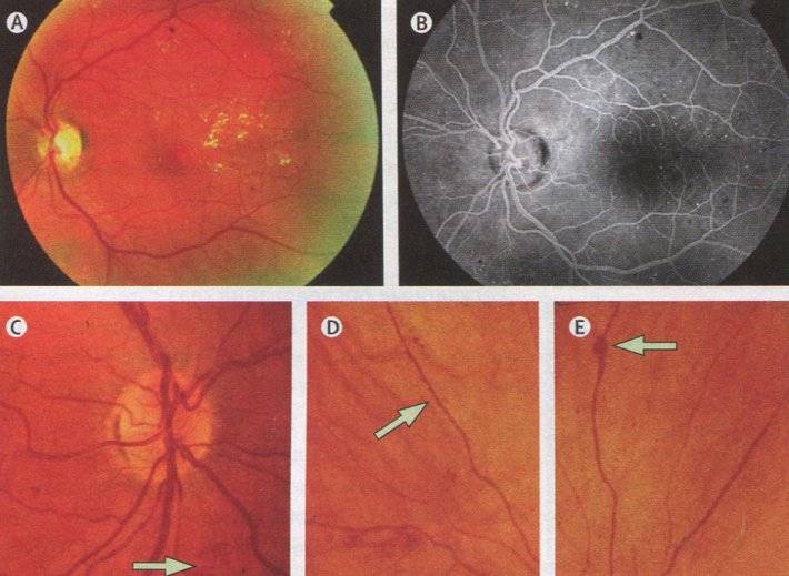 Диабетическая ретинопатия и ее симптомы