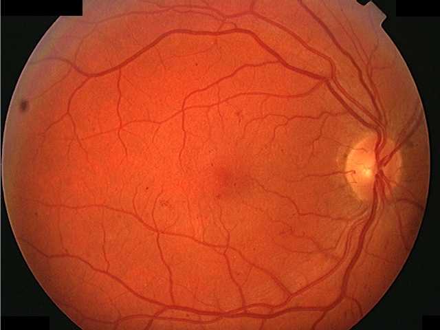 Ретинопатия сетчатки глаза: признаки и лечение oculistic.ru
ретинопатия сетчатки глаза: признаки и лечение