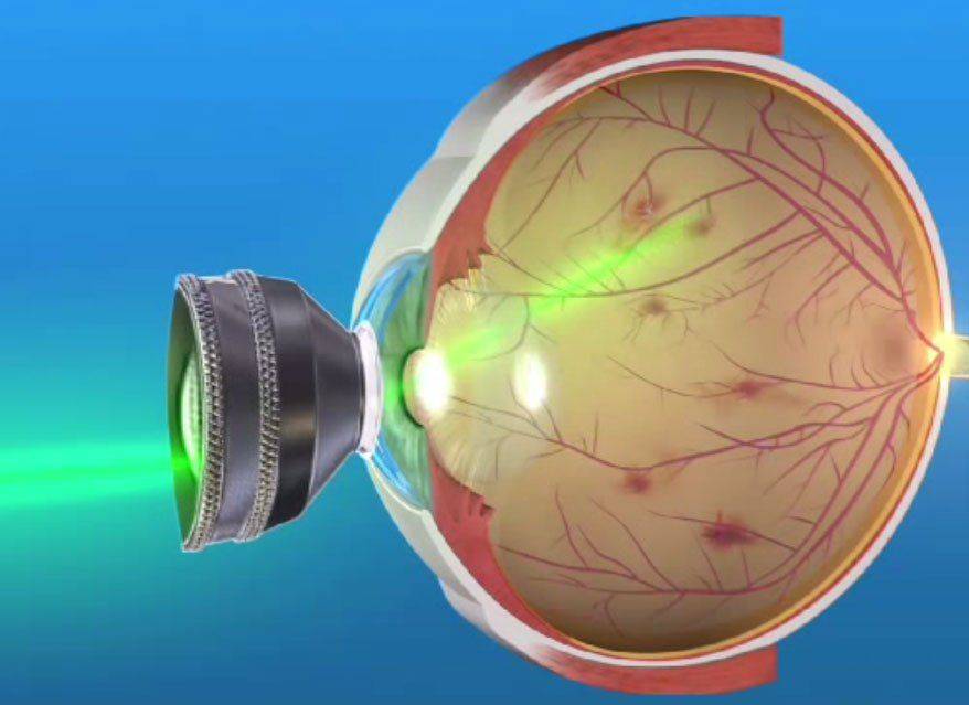 Восстановление сетчатки глаза