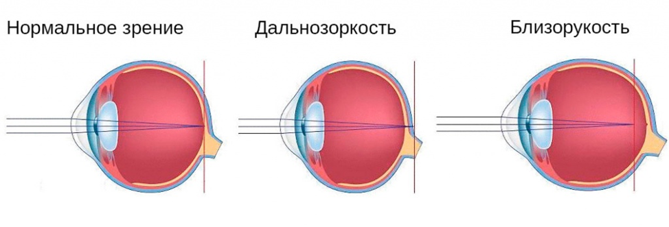Аккомодация глаза